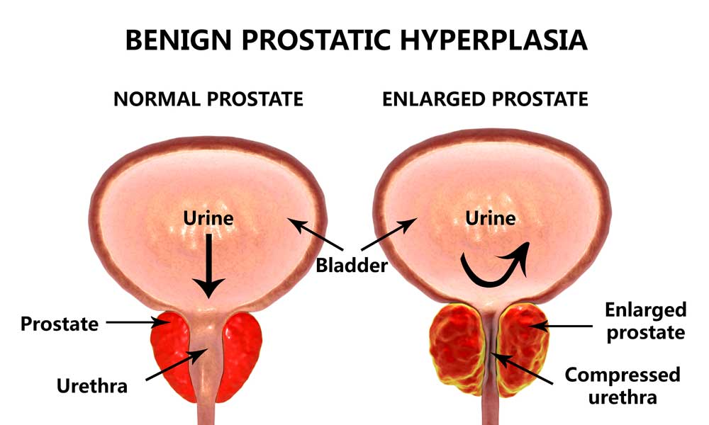 prostate