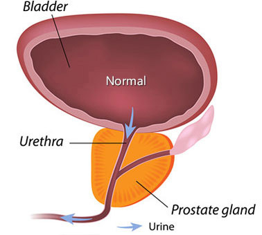 Prostate Enlargement Ayurvedic Medicine