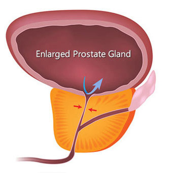 Ayurvedic Medicine For Prostate Gland Enlarged