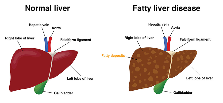 Ayurvedic Medicine For Fatty Liver