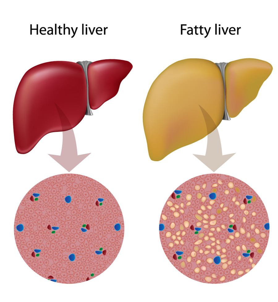 Ayurvedic Medicine For Fatty Liver